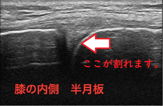 症例集 右膝内側半月板損傷の症例 かわうちはり灸整骨院 太田市 足利市