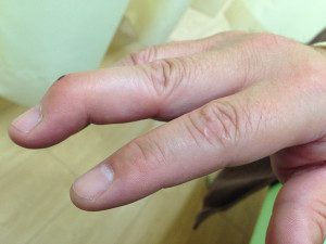 症例集 突き指による骨折 手術後のリハビリ症例 かわうちはり灸整骨院 太田市 足利市