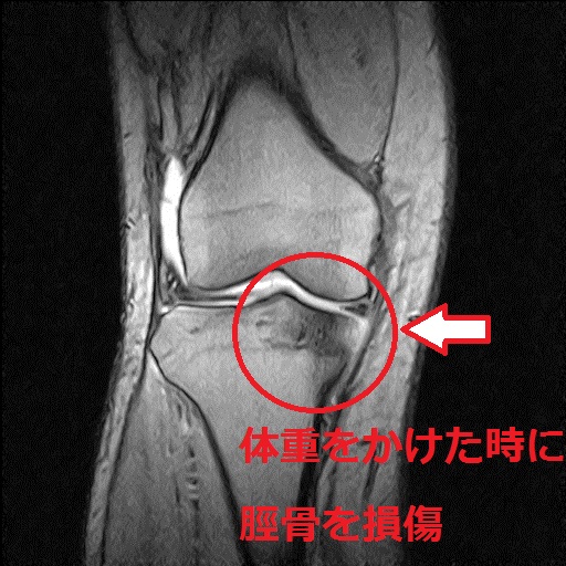 症例集 単なる膝の捻挫と思いきや 精密検査は大切です 太田市の患者さん かわうちはり灸整骨院 太田市 足利市