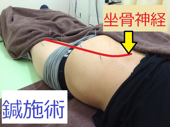 症例集：慢性的な腰の痛みに悩まれていたら鍼治療がオススメ ｜かわ